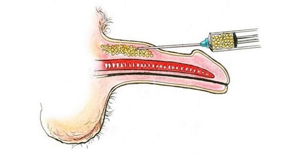 Injecții de acid hialuronic în butoiul unui membru pentru a -l crește